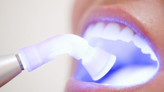 Best teeth whitening glasgow