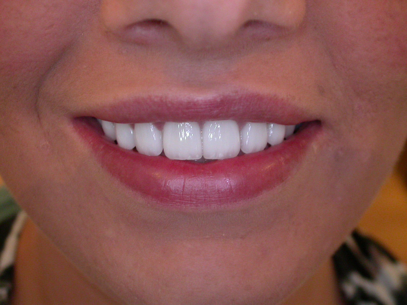 Veneers in Glasgow Glasgow Smile Clinic