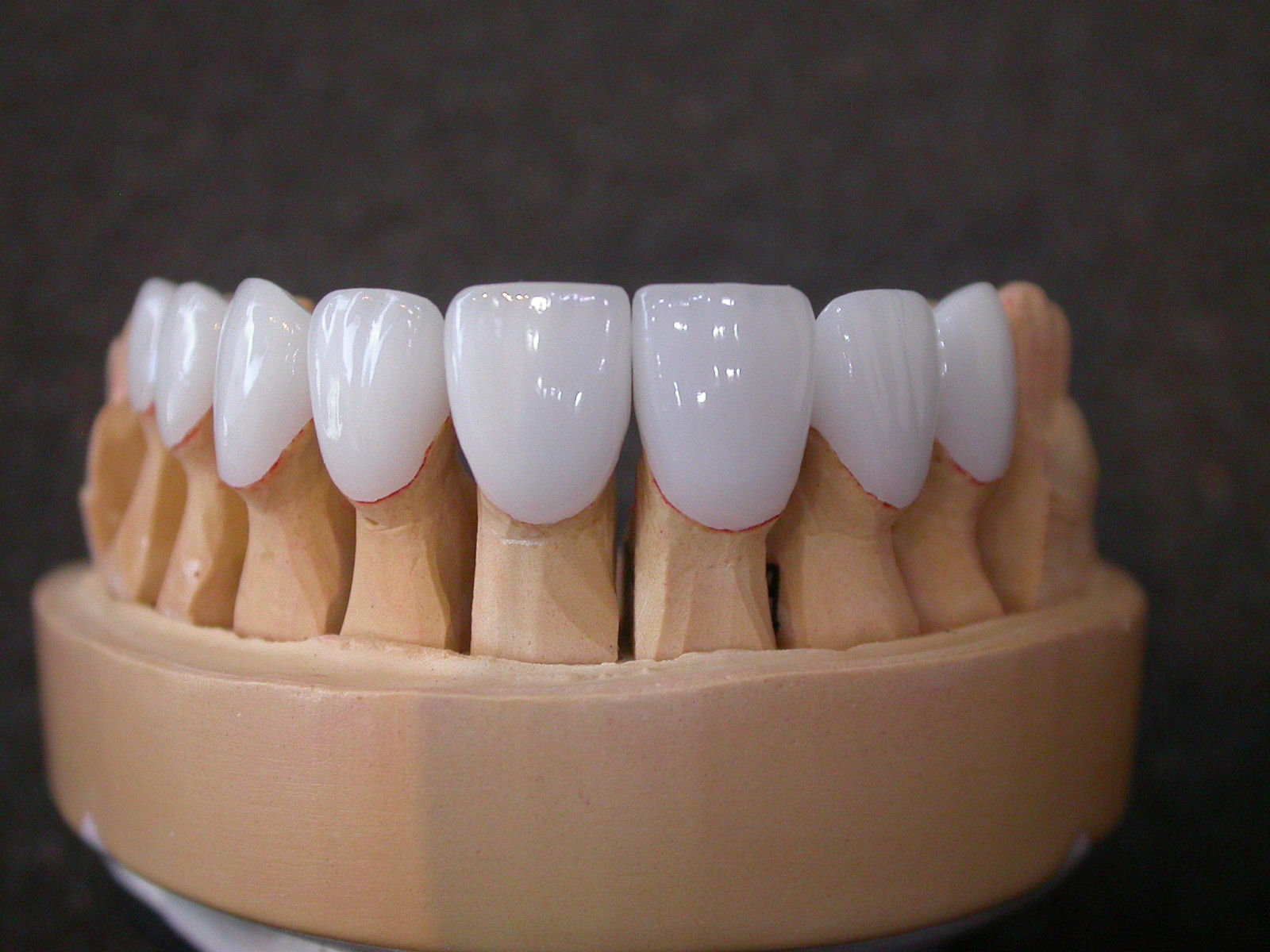 Veneers in Glasgow Glasgow Smile Clinic